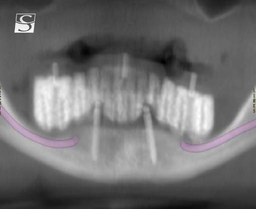 001aCamlog_Vario_SR_Abutments.jpg