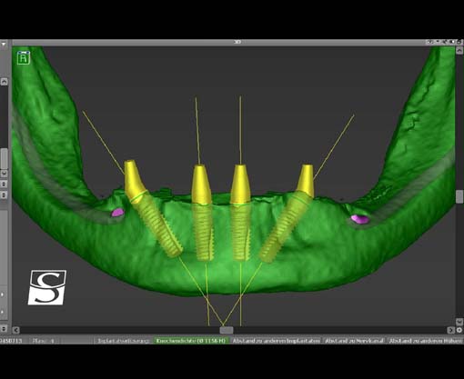 f004Camlog_Vario_SR_Abutments.jpg