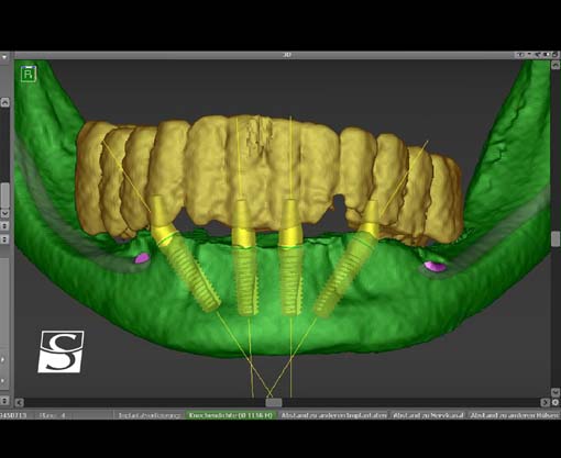 f005_KopieCamlog_Vario_SR_Abutments.jpg