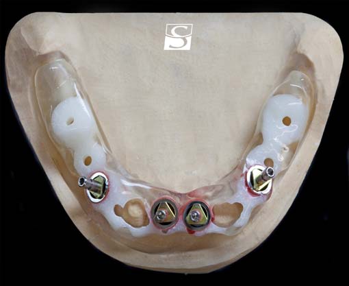 f009Camlog_Vario_SR_Abutments.jpg