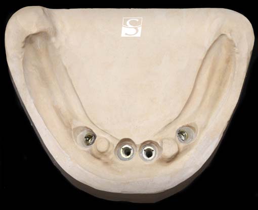 f010Camlog_Vario_SR_Abutments.jpg