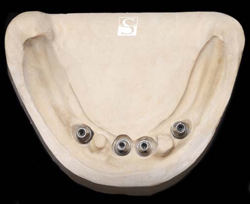 f011Camlog_Vario_SR_Abutments.jpg