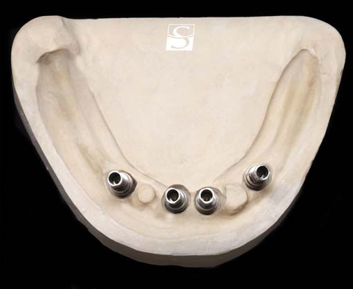 f012Camlog_Vario_SR_Abutments.jpg