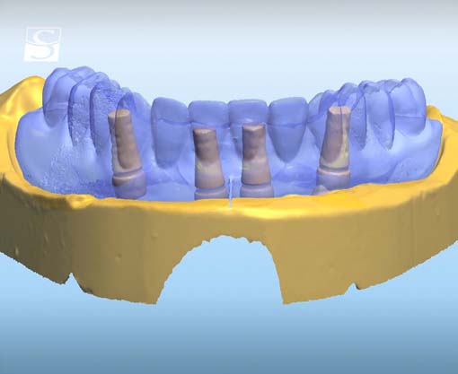 f014Camlog_Vario_SR_Abutments.jpg