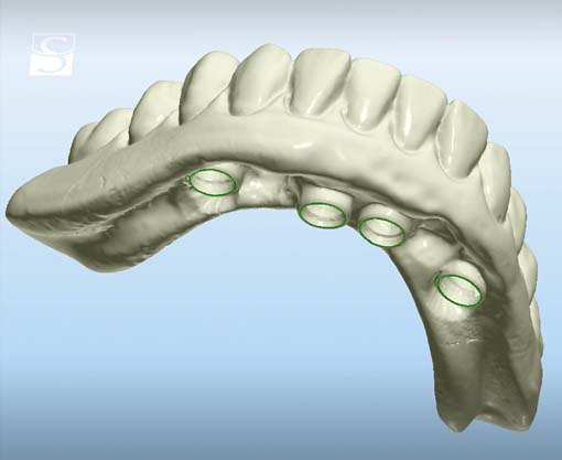 f016Camlog_Vario_SR_Abutments.jpg