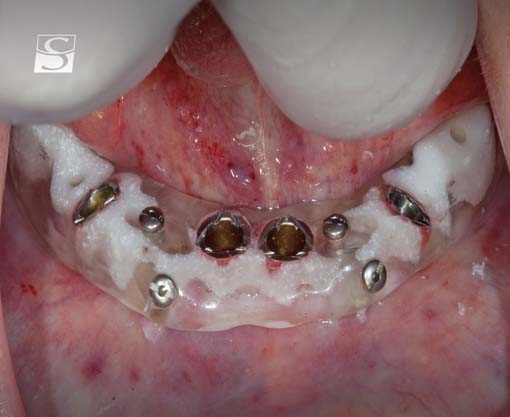 f022Camlog_Vario_SR_Abutments.jpg