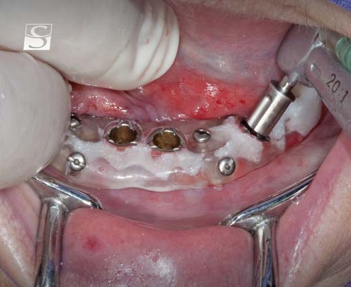 f023Camlog_Vario_SR_Abutments.jpg