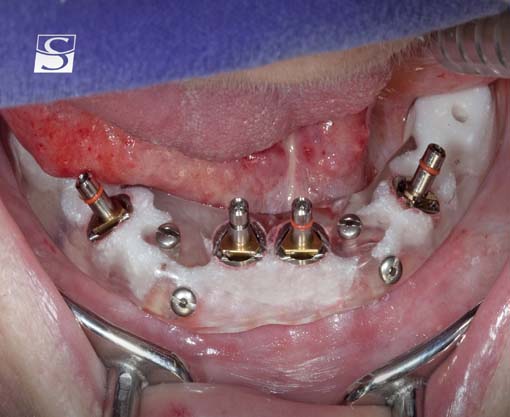 f024Camlog_Vario_SR_Abutments.jpg