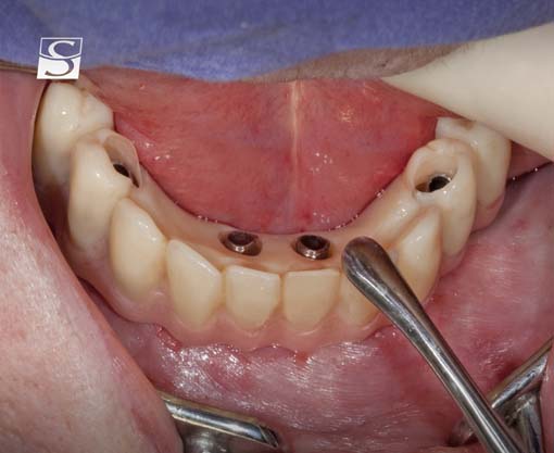 f027Camlog_Vario_SR_Abutments.jpg