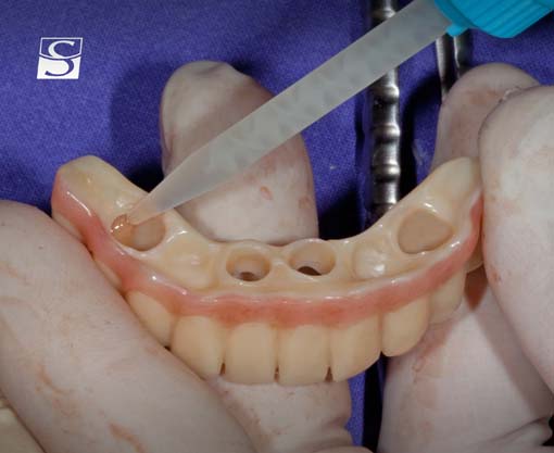 f028Camlog_Vario_SR_Abutments.jpg