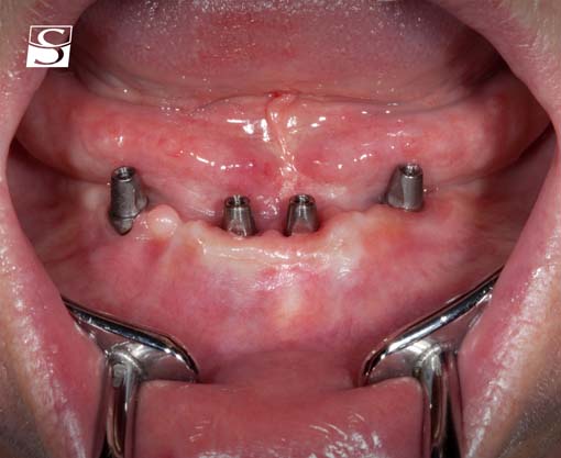 vario003Schuldes_Camlog_Vario_SR_Abutments.jpg
