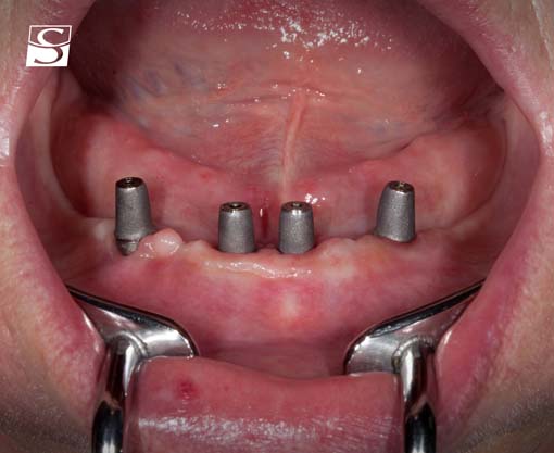 vario004Schuldes_Camlog_Vario_SR_Abutments.jpg