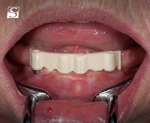 vario005Schuldes_Camlog_Vario_SR_Abutments.jpg