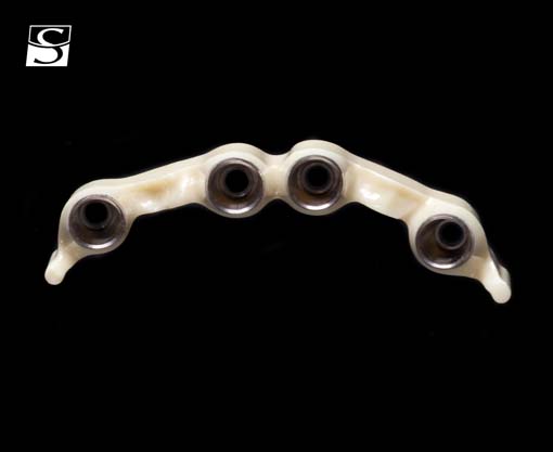vario006Schuldes_Camlog_Vario_SR_Abutments.jpg