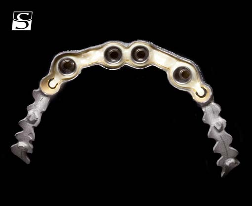 vario007Schuldes_Camlog_Vario_SR_Abutments.jpg