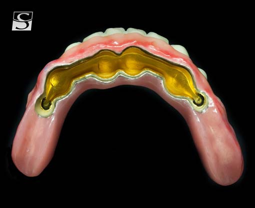 vario009Schuldes_Camlog_Vario_SR_Abutments.jpg