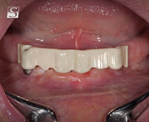 vario012Schuldes_Camlog_Vario_SR_Abutments.jpg